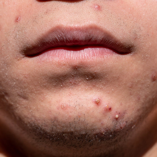 Man with acne-prone skin on the face and back receiving natural care tips