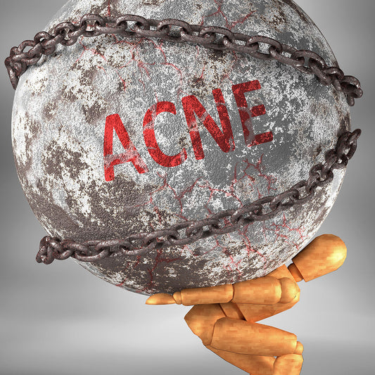 Woman with stress-related acne exploring the mind-skin connection