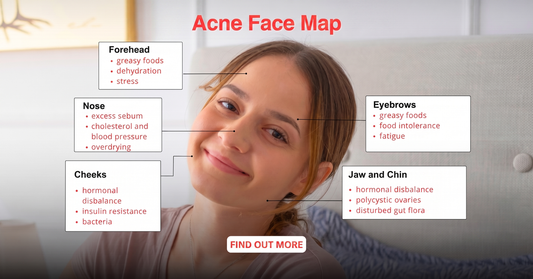 Acne face map showing which face zone signals which internal imbalance