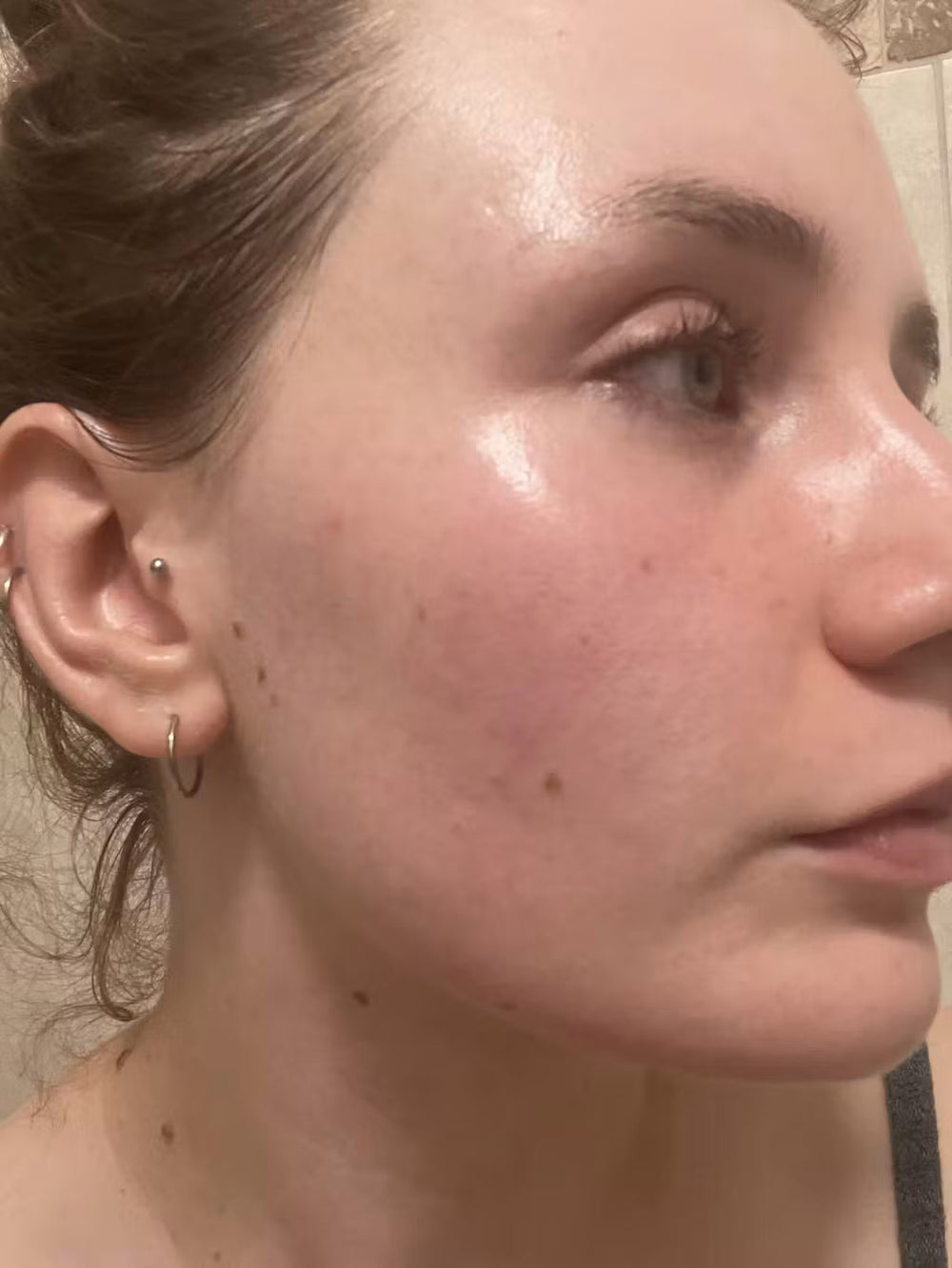 acne AU keep