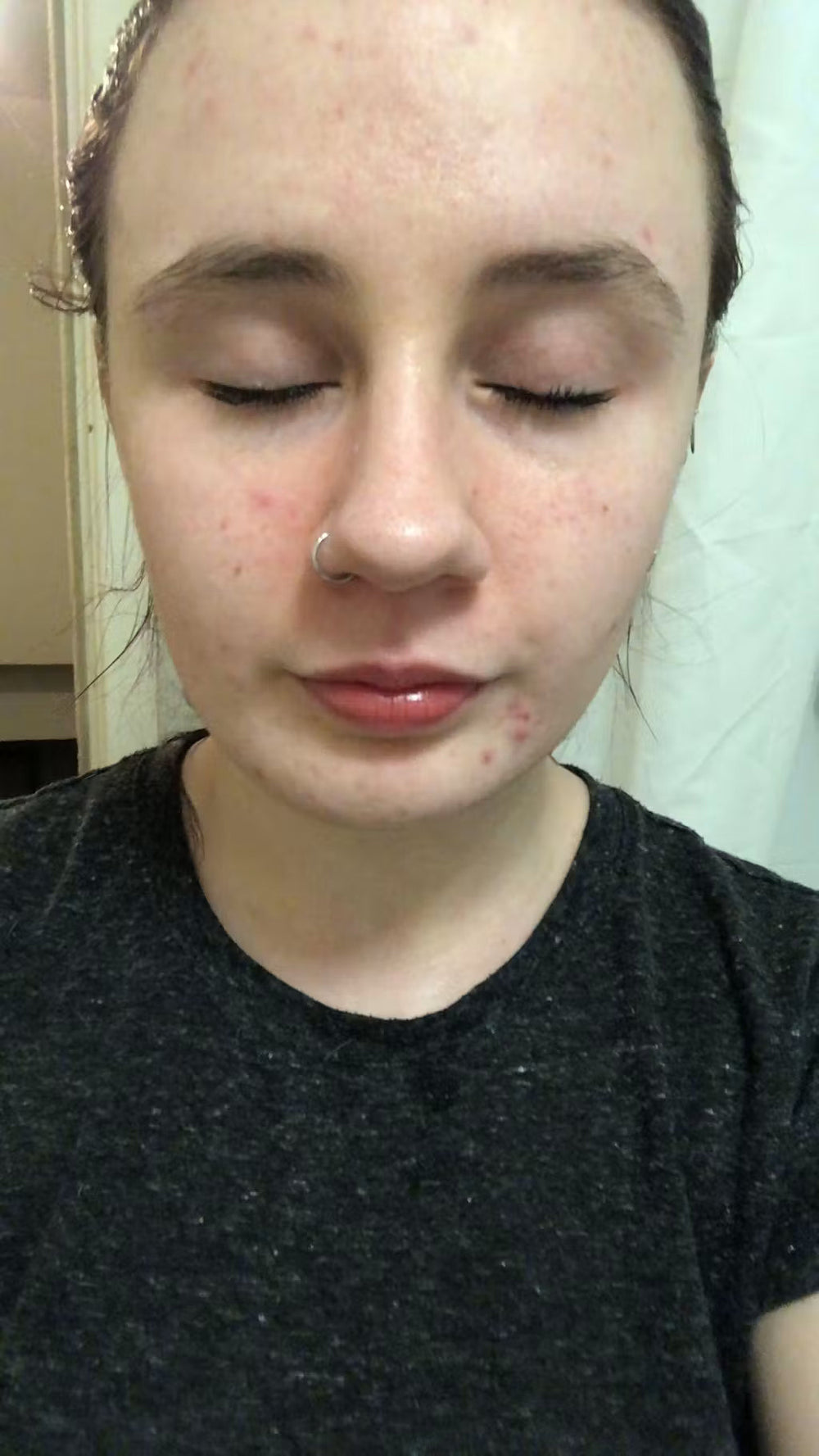 acne AU keep