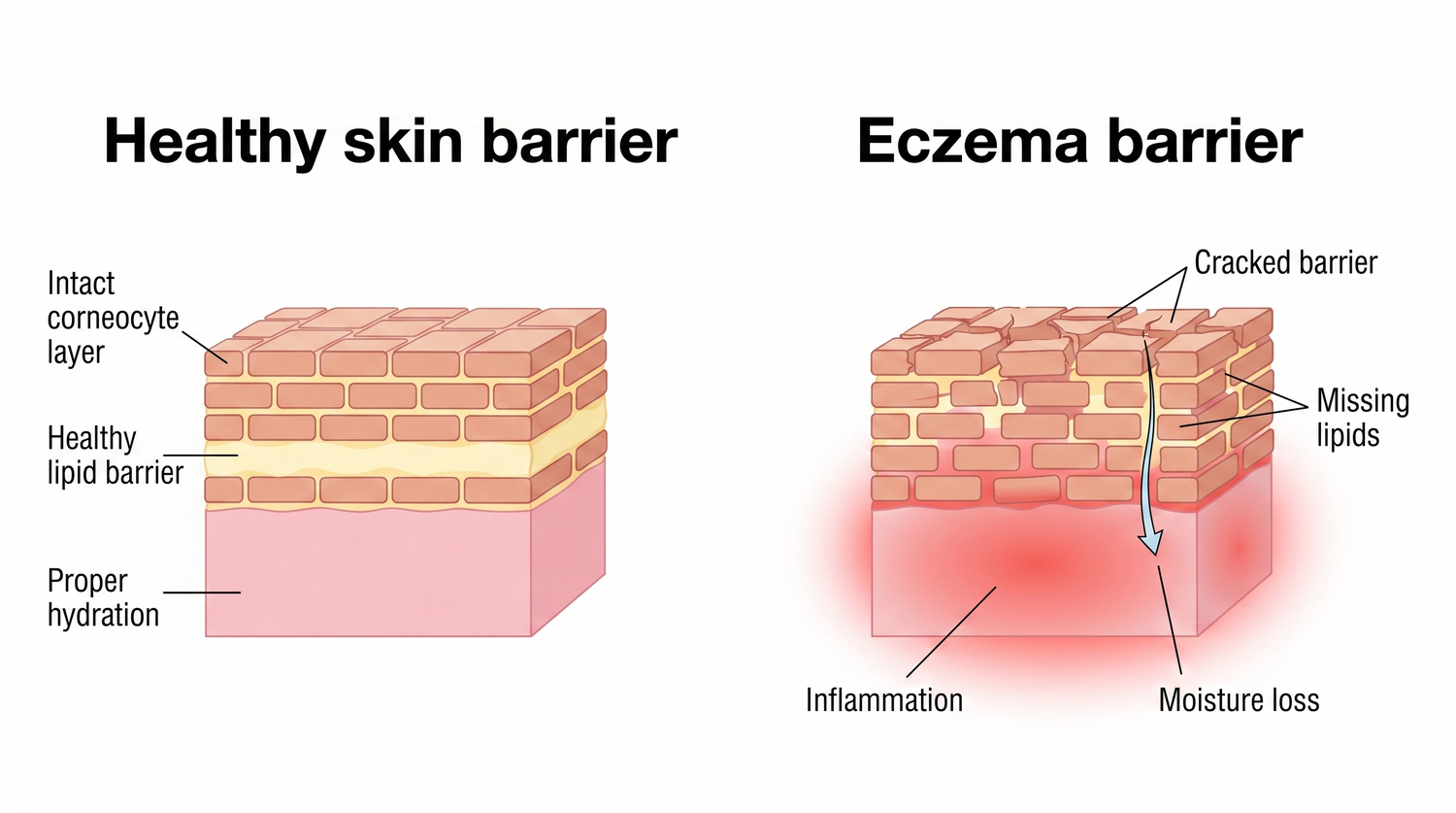 eczema