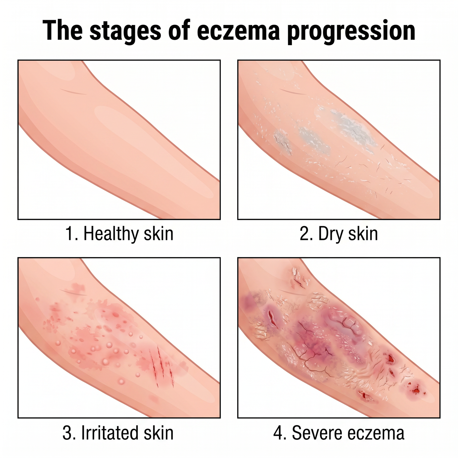 eczema