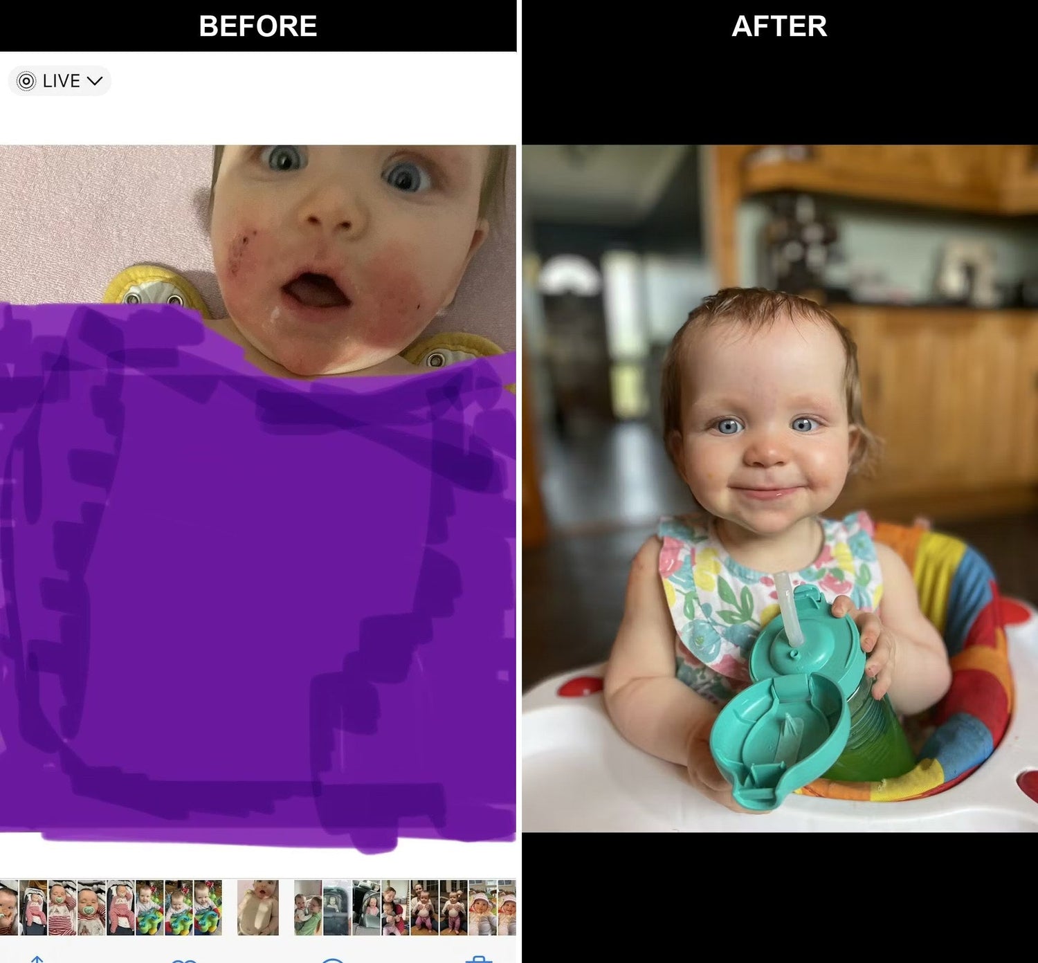 eczema