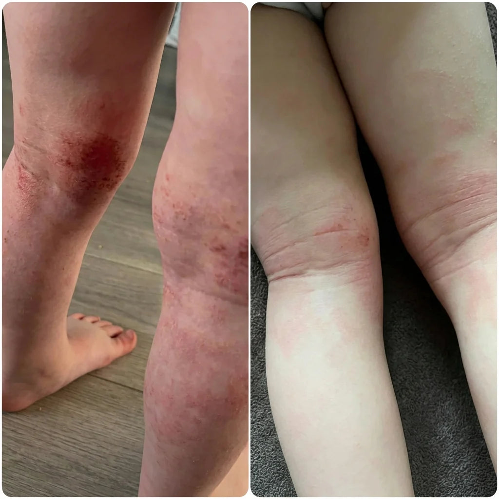 eczema
